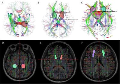 White Matter Abnormalities of Auditory Neural Pathway in Sudden Sensorineural Hearing Loss Using Diffusion Spectrum Imaging: Different Findings From Tinnitus